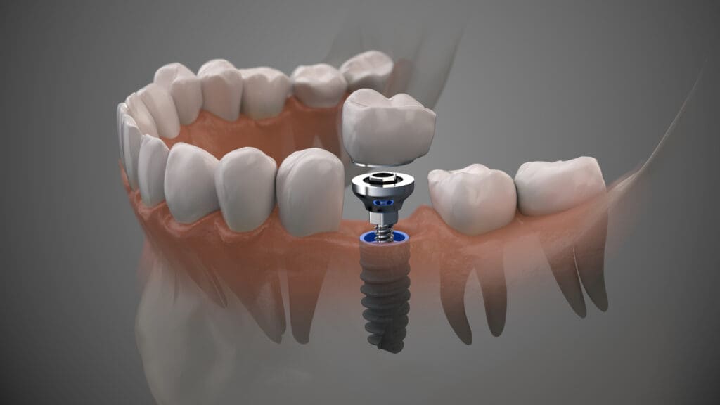 dental implants Ashburn